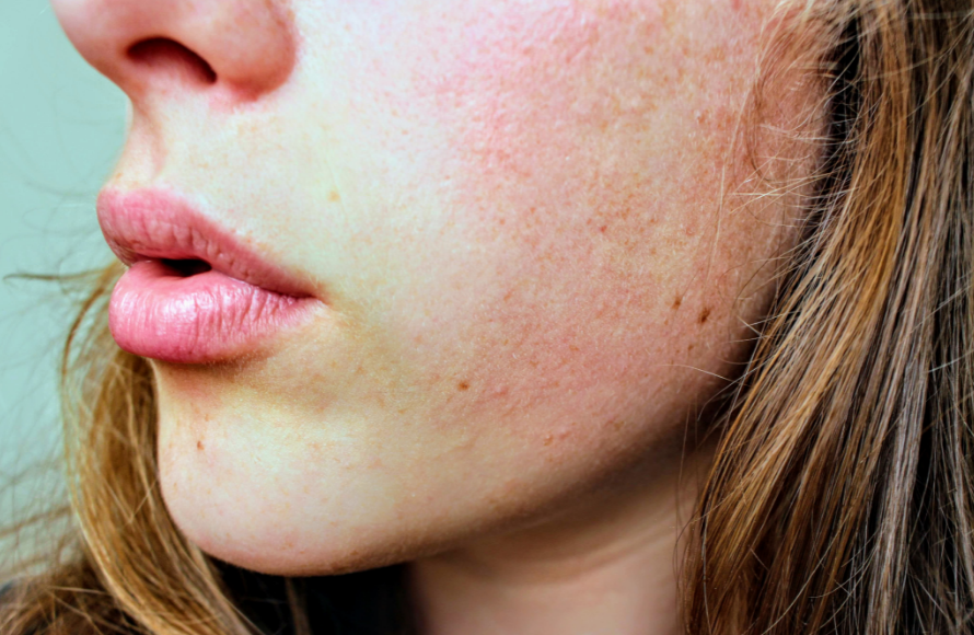 Close up of woman's face with red, irritated skin
