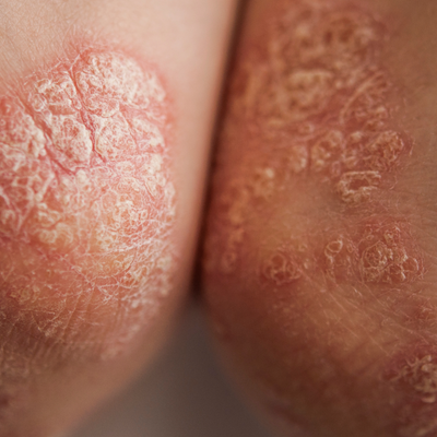 Psoriasis Flare-Ups: Gentle Products and Holistic Tips That Help